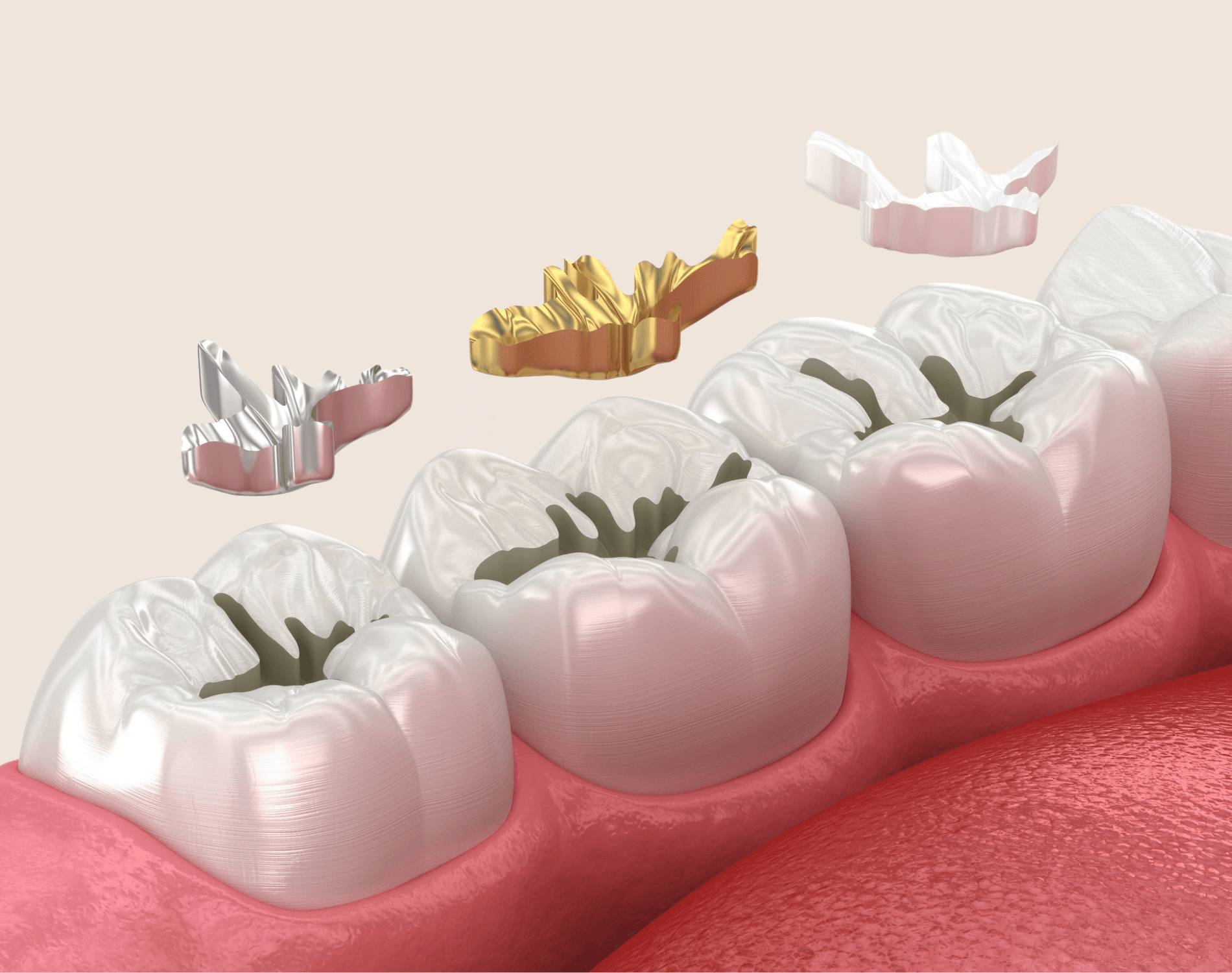 Illustration of tooth-colored, gold and silver fillings fitting into molars
